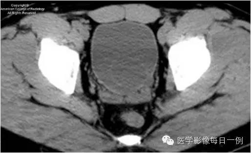 【病例】输尿管囊肿1例CT影像表现 【病例】输尿管囊肿1例CT影像表现