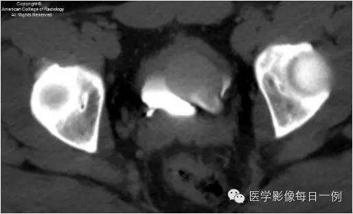 【病例】输尿管囊肿1例CT影像表现 【病例】输尿管囊肿1例CT影像表现