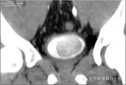 【病例】输尿管囊肿1例CT影像表现 【病例】输尿管囊肿1例CT影像表现