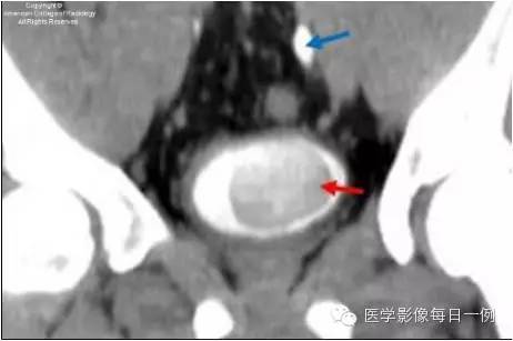 【病例】输尿管囊肿1例CT影像表现 【病例】输尿管囊肿1例CT影像表现