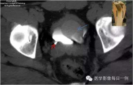 【病例】输尿管囊肿1例CT影像表现