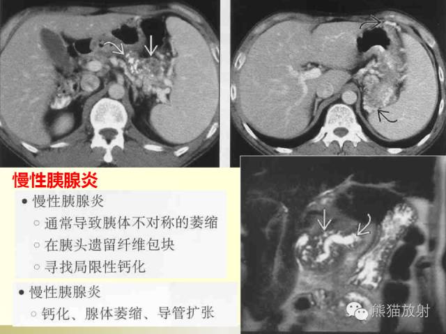 【PPT】浅谈胰腺CT增强扫描、胰周血管解剖及评价 胰腺病变诊断