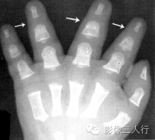 "三叉戟征"，这个征象提示啥？