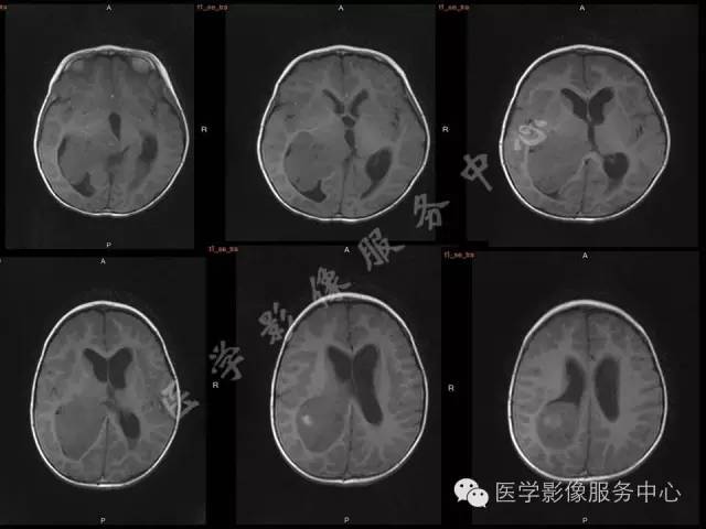 【病例】幼儿侧脑室胶质母细胞瘤1例MR影像表现