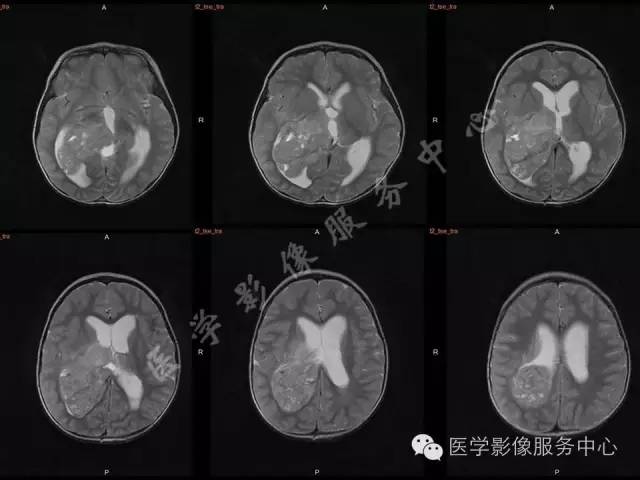 【病例】幼儿侧脑室胶质母细胞瘤1例MR影像表现