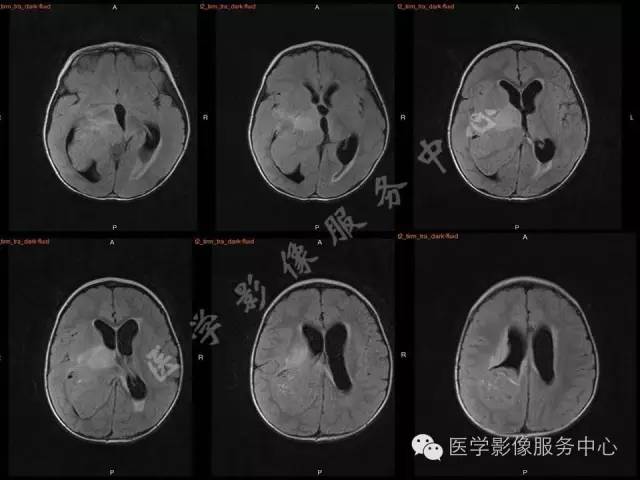 【病例】幼儿侧脑室胶质母细胞瘤1例MR影像表现