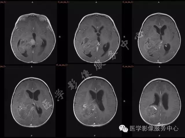 【病例】幼儿侧脑室胶质母细胞瘤1例MR影像表现