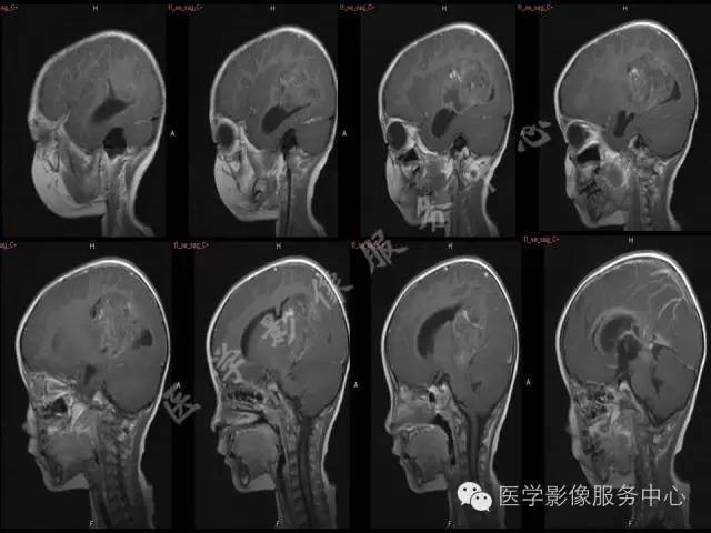 【病例】幼儿侧脑室胶质母细胞瘤1例MR影像表现