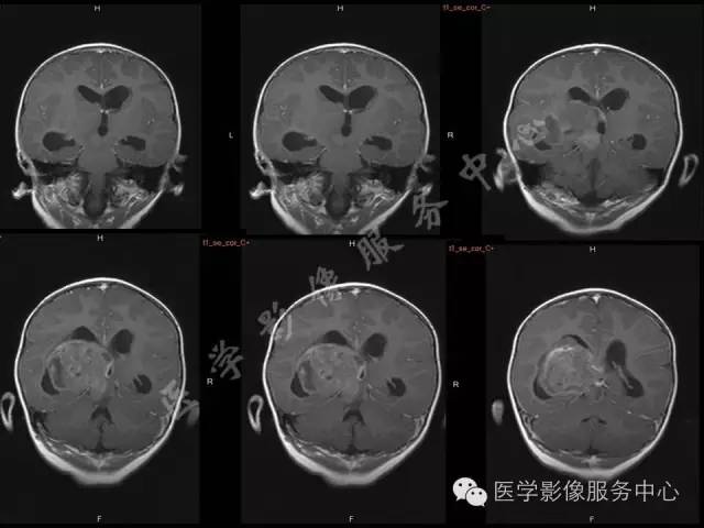 【病例】幼儿侧脑室胶质母细胞瘤1例MR影像表现