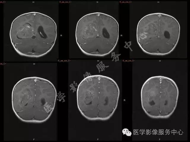 【病例】幼儿侧脑室胶质母细胞瘤1例MR影像表现