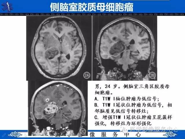 【病例】幼儿侧脑室胶质母细胞瘤1例MR影像表现