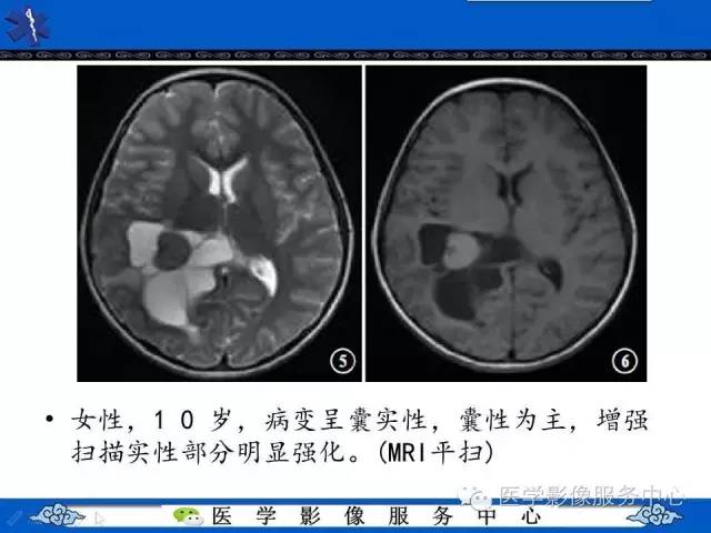 【病例】幼儿侧脑室胶质母细胞瘤1例MR影像表现