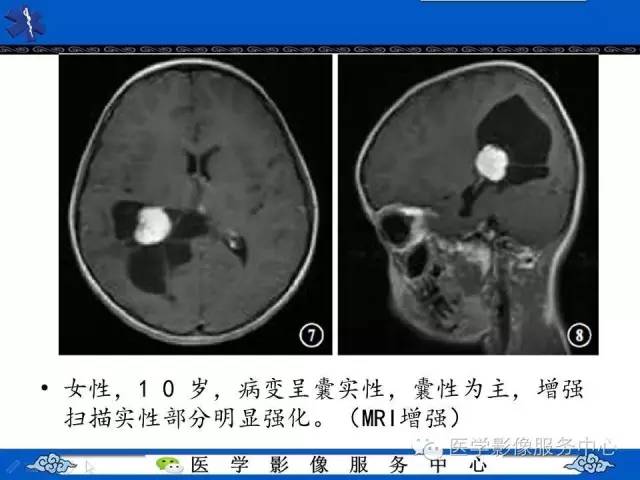 【病例】幼儿侧脑室胶质母细胞瘤1例MR影像表现