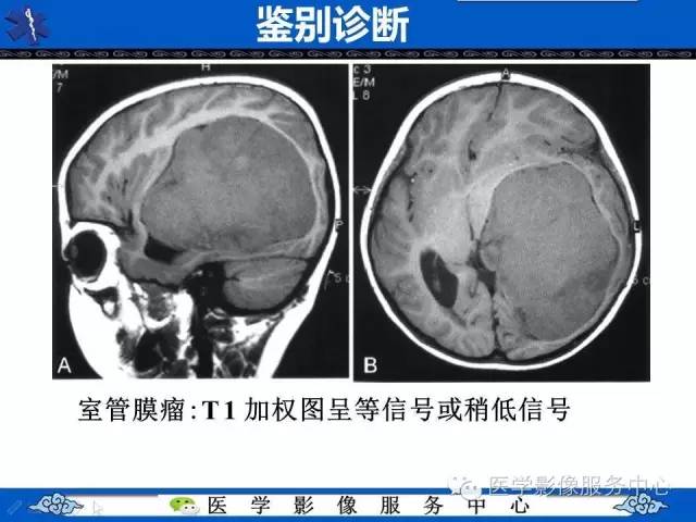 【病例】幼儿侧脑室胶质母细胞瘤1例MR影像表现