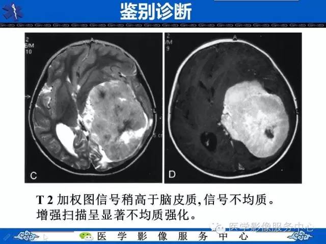 【病例】幼儿侧脑室胶质母细胞瘤1例MR影像表现