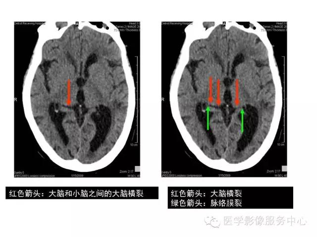 【PPT】这些头颅CT解剖结构你知道吗