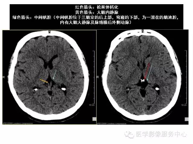 【PPT】这些头颅CT解剖结构你知道吗