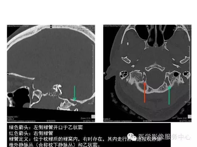 【PPT】这些头颅CT解剖结构你知道吗