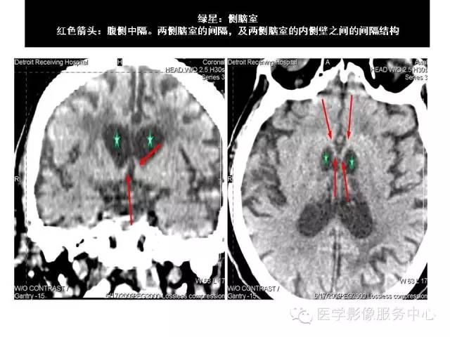 【PPT】这些头颅CT解剖结构你知道吗