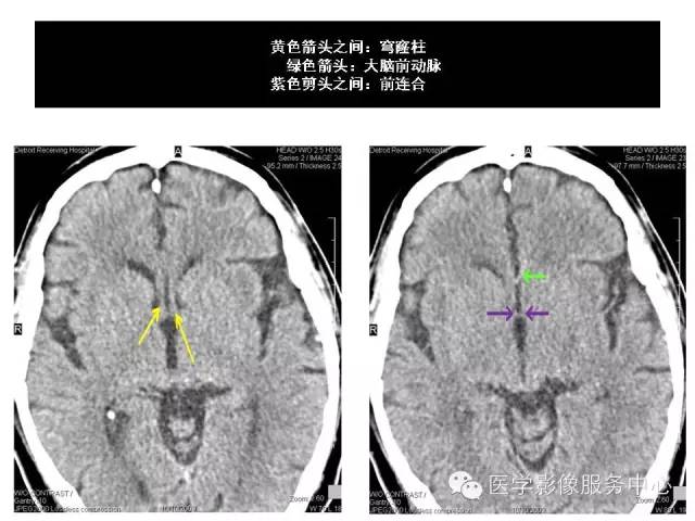 【PPT】这些头颅CT解剖结构你知道吗