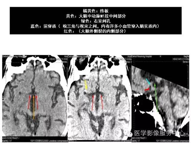 【PPT】这些头颅CT解剖结构你知道吗