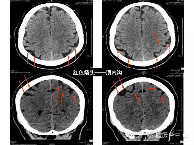 【PPT】这些头颅CT解剖结构你知道吗