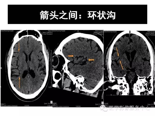 【PPT】这些头颅CT解剖结构你知道吗