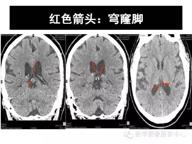 【PPT】这些头颅CT解剖结构你知道吗