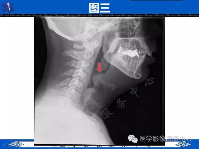 【影像征象】拇指征