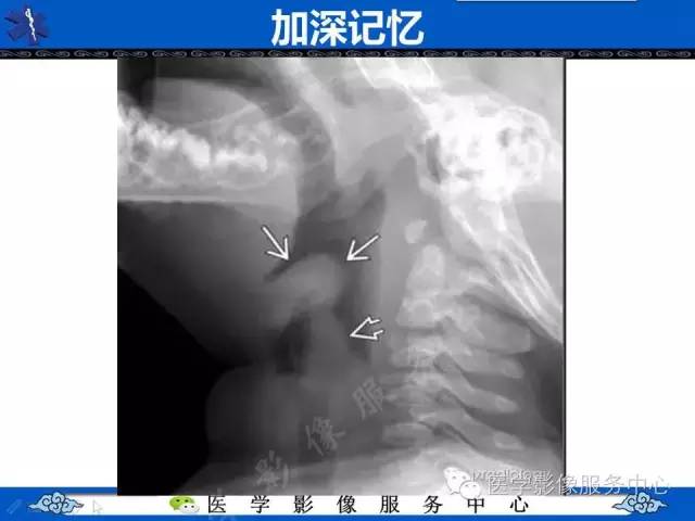 【影像征象】拇指征