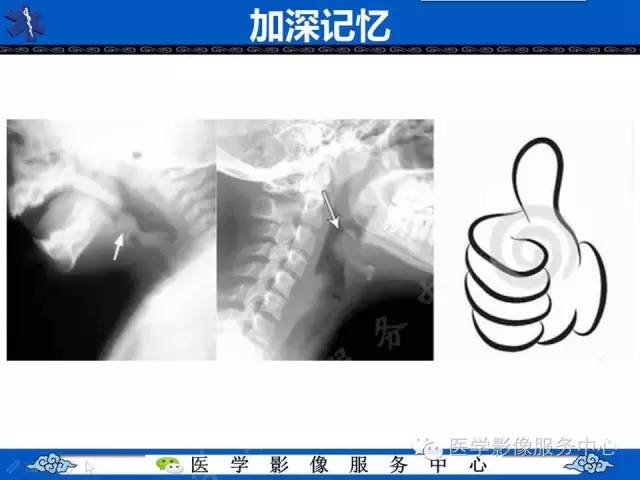 【影像征象】拇指征