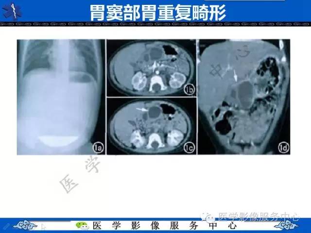 【病例】胃重复畸形1例CT影像表现
