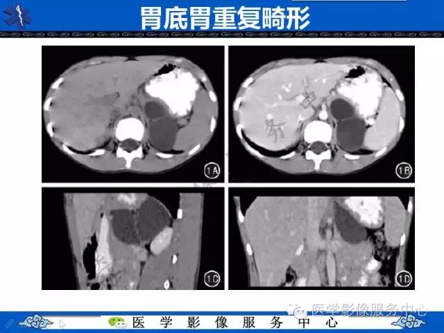 【病例】胃重复畸形1例CT影像表现