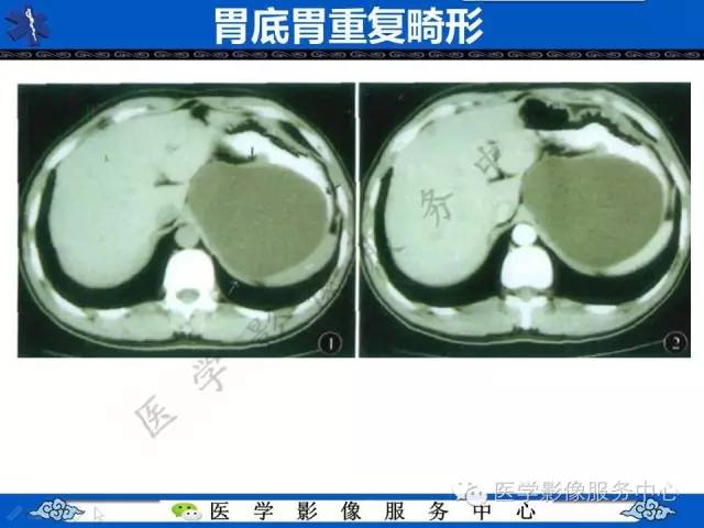 【病例】胃重复畸形1例CT影像表现
