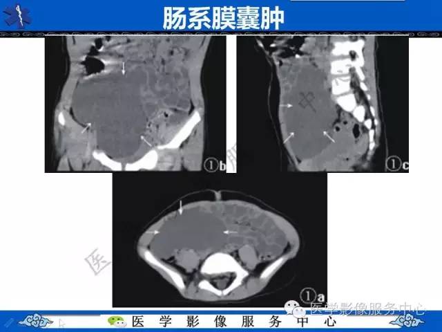 【病例】胃重复畸形1例CT影像表现