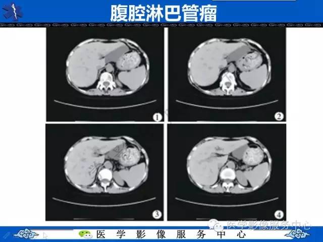 【病例】胃重复畸形1例CT影像表现