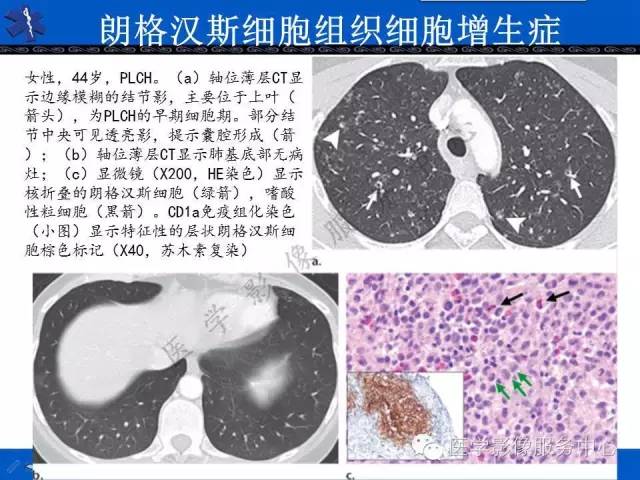 【PPT】胸部组织细胞病变的影像学表现