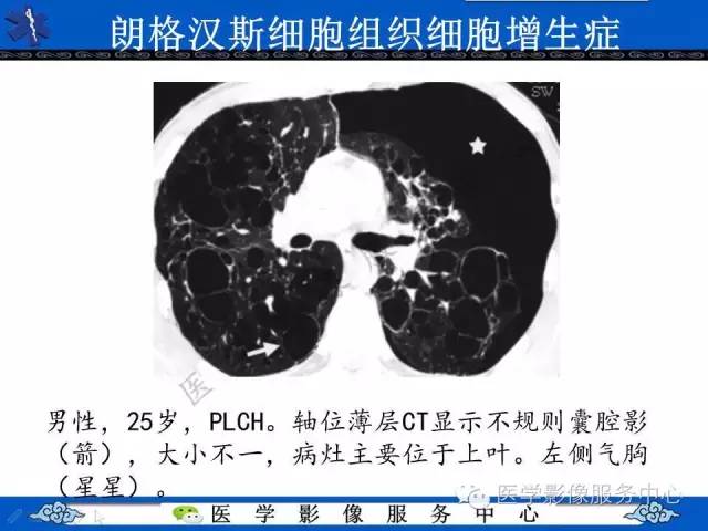 【PPT】胸部组织细胞病变的影像学表现