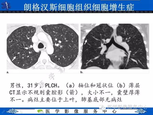 【PPT】胸部组织细胞病变的影像学表现