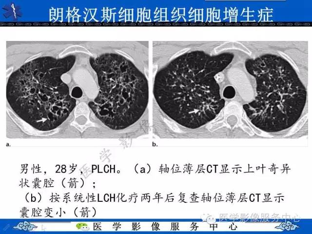 【PPT】胸部组织细胞病变的影像学表现