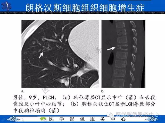 【PPT】胸部组织细胞病变的影像学表现