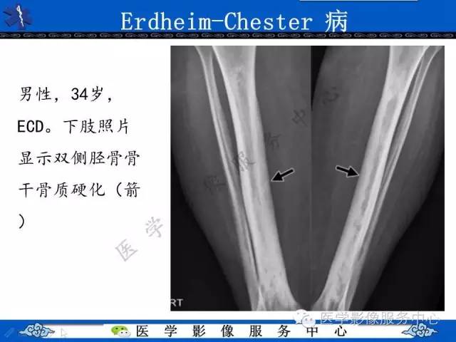 【PPT】胸部组织细胞病变的影像学表现