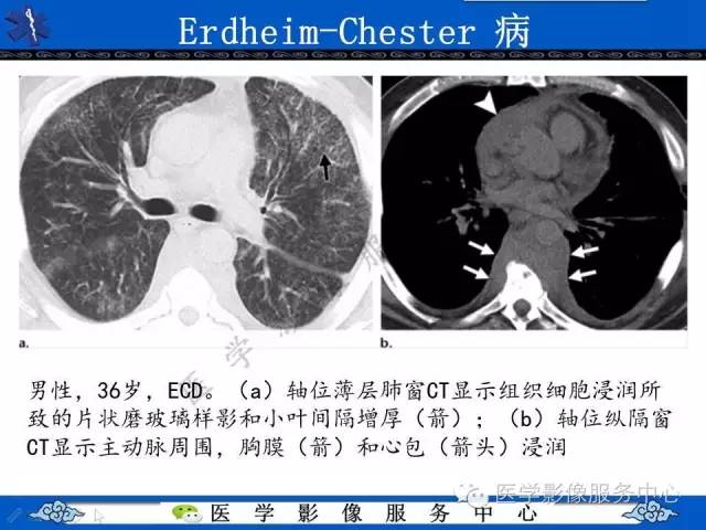 【PPT】胸部组织细胞病变的影像学表现