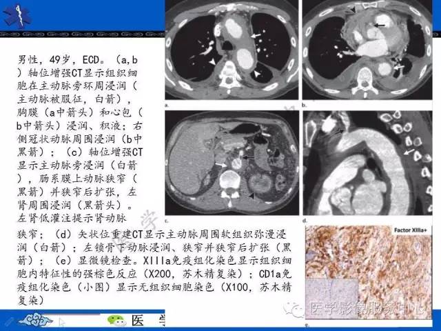 【PPT】胸部组织细胞病变的影像学表现