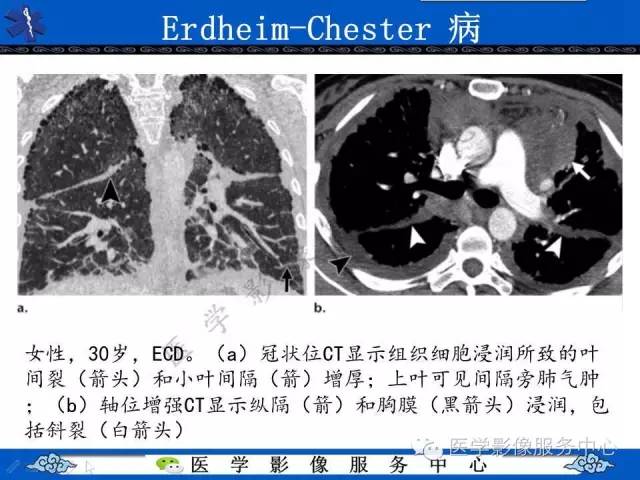 【PPT】胸部组织细胞病变的影像学表现