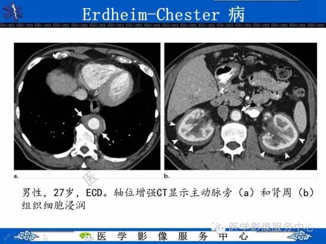 【PPT】胸部组织细胞病变的影像学表现