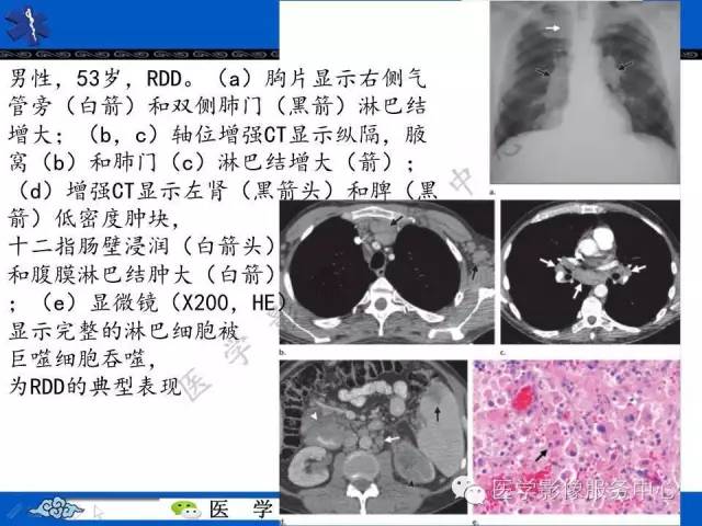 【PPT】胸部组织细胞病变的影像学表现
