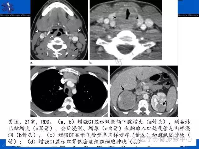 【PPT】胸部组织细胞病变的影像学表现