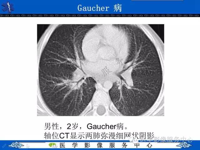 【PPT】胸部组织细胞病变的影像学表现