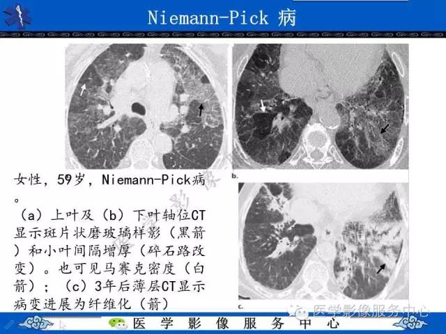 【PPT】胸部组织细胞病变的影像学表现